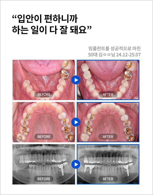 수원치과, 수원임플란트, 수원교정치과, 수원전체임플란트, 수원치아교정, 수원충치치료, 수원보철치료, 수원턱관절, 수원사랑니, 수원화이트드림치과