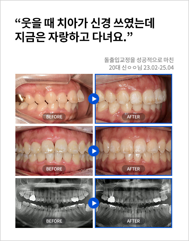 수원치과, 수원임플란트, 수원교정치과, 수원전체임플란트, 수원치아교정, 수원충치치료, 수원보철치료, 수원턱관절, 수원사랑니, 수원화이트드림치과
