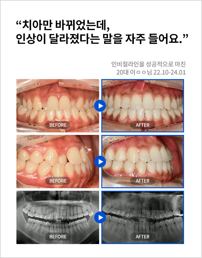 수원치과, 수원임플란트, 수원교정치과, 수원전체임플란트, 수원치아교정, 수원충치치료, 수원보철치료, 수원턱관절, 수원사랑니, 수원화이트드림치과