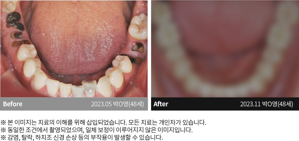 수원치과, 수원임플란트, 수원교정치과, 수원전체임플란트, 수원치아교정, 수원충치치료, 수원보철치료, 수원턱관절, 수원사랑니, 수원화이트드림치과