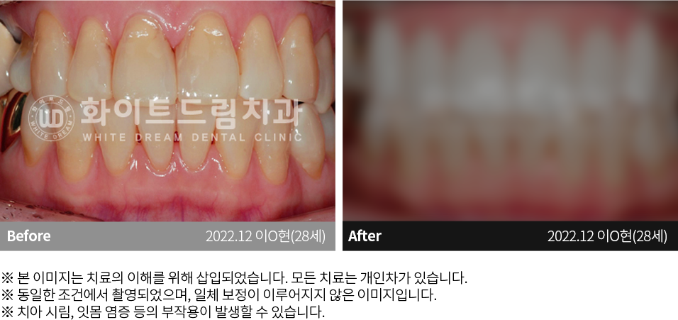 수원치과, 수원임플란트, 수원교정치과, 수원전체임플란트, 수원치아교정, 수원충치치료, 수원보철치료, 수원턱관절, 수원사랑니, 수원화이트드림치과