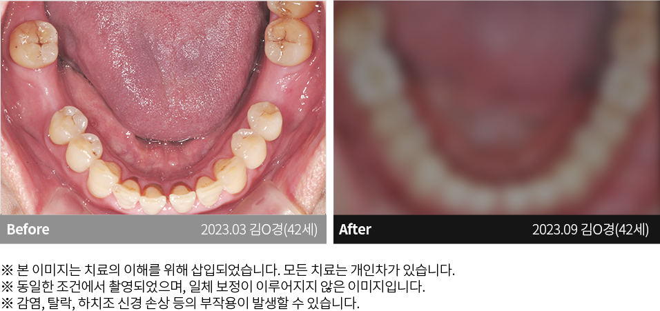 수원치과, 수원임플란트, 수원교정치과, 수원전체임플란트, 수원치아교정, 수원충치치료, 수원보철치료, 수원턱관절, 수원사랑니, 수원화이트드림치과