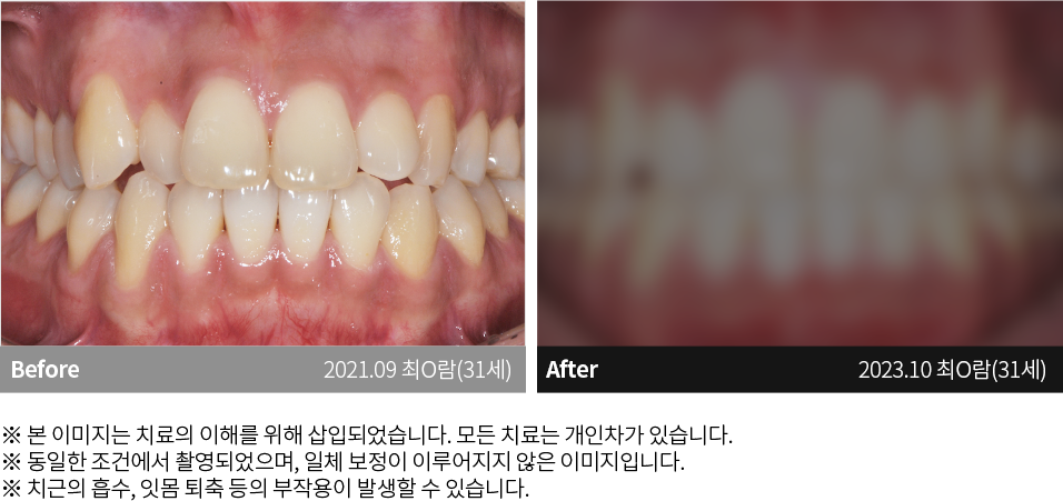 수원치과, 수원임플란트, 수원교정치과, 수원전체임플란트, 수원치아교정, 수원충치치료, 수원보철치료, 수원턱관절, 수원사랑니, 수원화이트드림치과