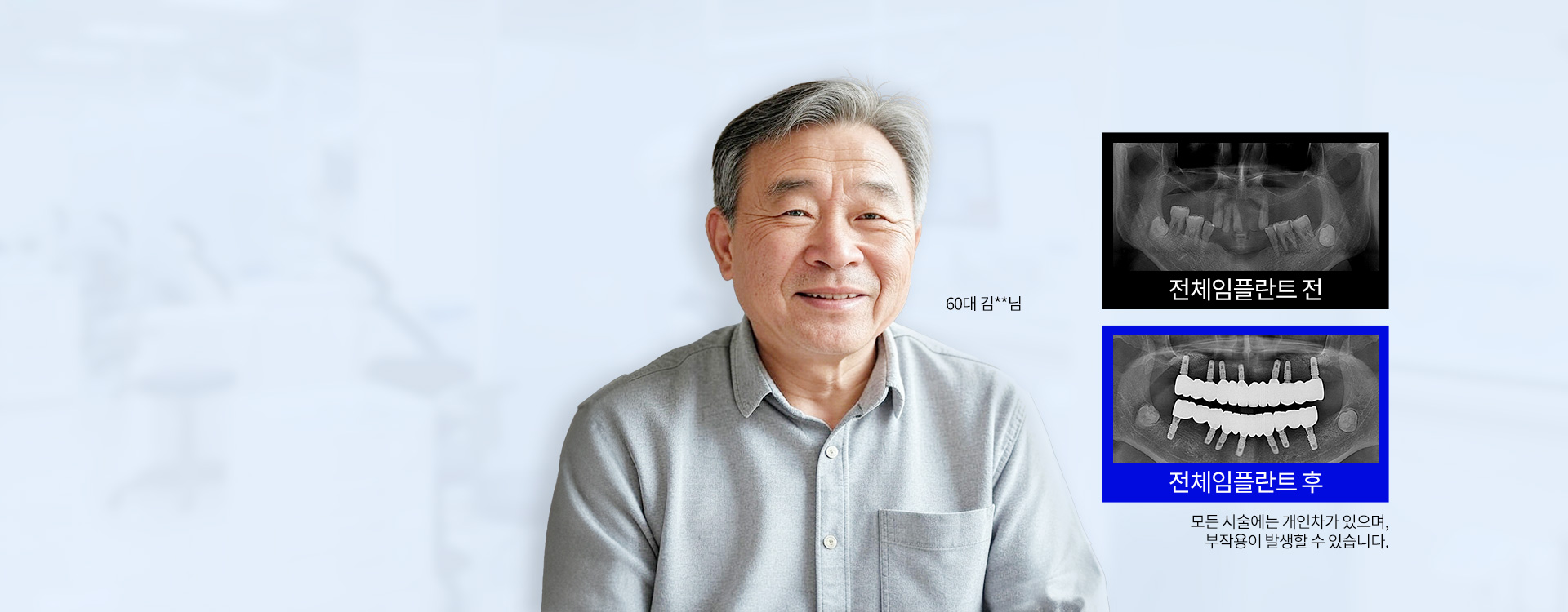 수원임플란트, 전체임플란트, 전악임플란트, 수원화이트드림치과