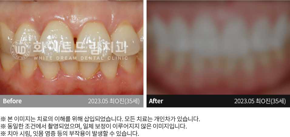 수원치과, 수원임플란트, 수원교정치과, 수원전체임플란트, 수원치아교정, 수원충치치료, 수원보철치료, 수원턱관절, 수원사랑니, 수원화이트드림치과