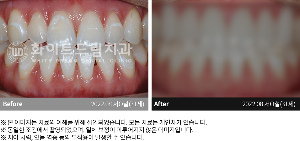 수원치과, 수원임플란트, 수원교정치과, 수원전체임플란트, 수원치아교정, 수원충치치료, 수원보철치료, 수원턱관절, 수원사랑니, 수원화이트드림치과