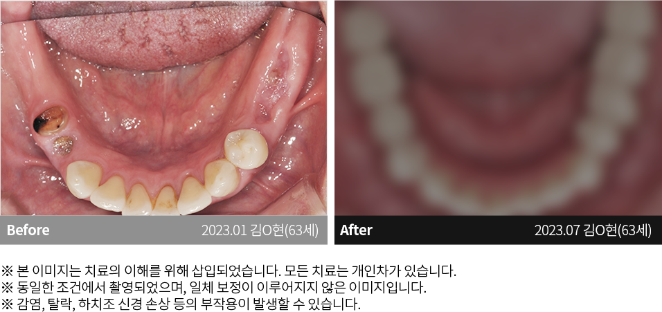 수원치과, 수원임플란트, 수원교정치과, 수원전체임플란트, 수원치아교정, 수원충치치료, 수원보철치료, 수원턱관절, 수원사랑니, 수원화이트드림치과
