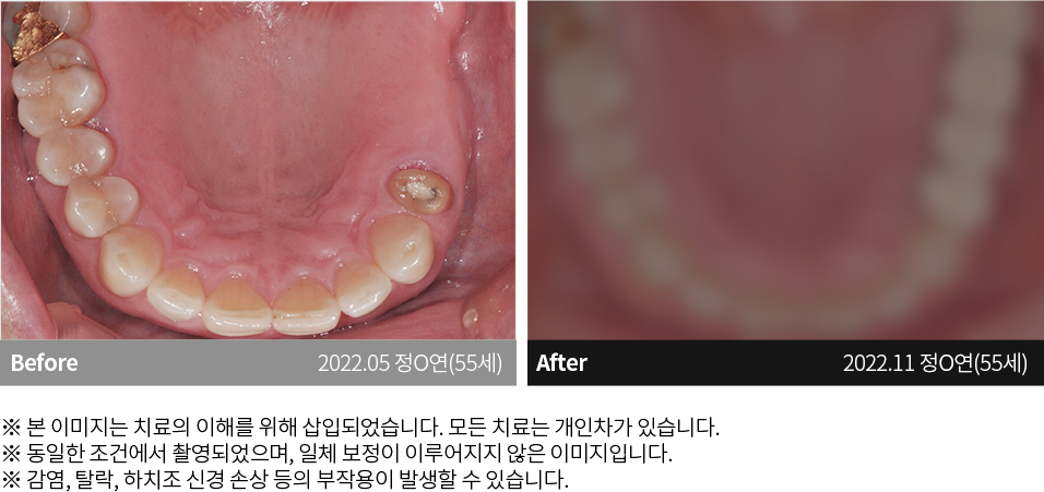 수원치과, 수원임플란트, 수원교정치과, 수원전체임플란트, 수원치아교정, 수원충치치료, 수원보철치료, 수원턱관절, 수원사랑니, 수원화이트드림치과