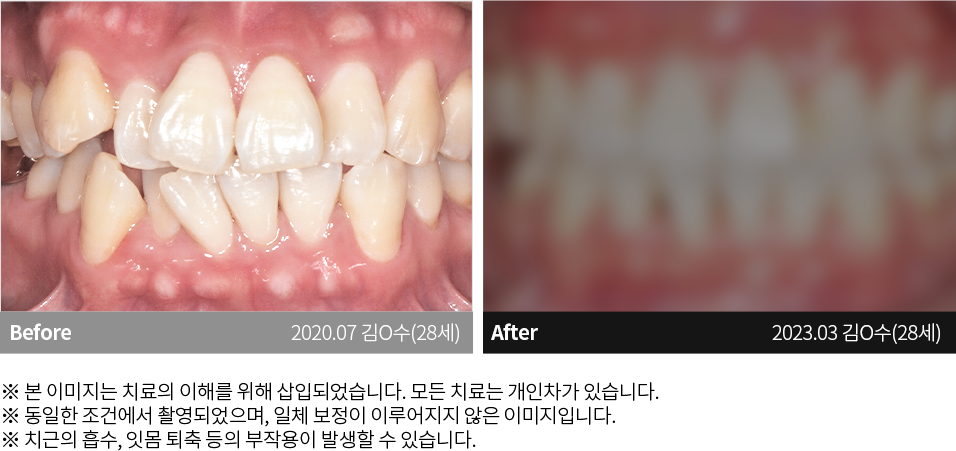 수원치과, 수원임플란트, 수원교정치과, 수원전체임플란트, 수원치아교정, 수원충치치료, 수원보철치료, 수원턱관절, 수원사랑니, 수원화이트드림치과