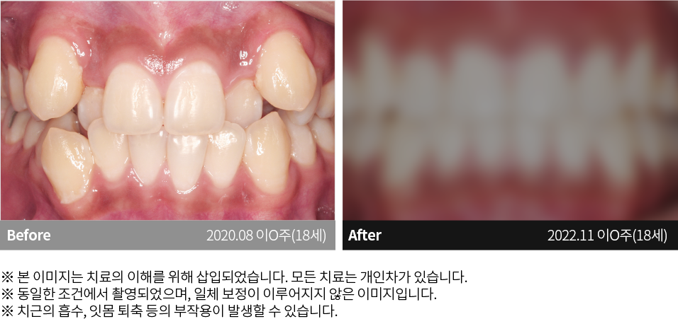 수원치과, 수원임플란트, 수원교정치과, 수원전체임플란트, 수원치아교정, 수원충치치료, 수원보철치료, 수원턱관절, 수원사랑니, 수원화이트드림치과