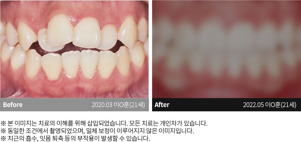 수원치과, 수원임플란트, 수원교정치과, 수원전체임플란트, 수원치아교정, 수원충치치료, 수원보철치료, 수원턱관절, 수원사랑니, 수원화이트드림치과