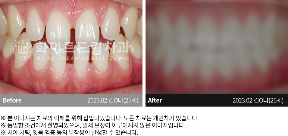 수원치과, 수원임플란트, 수원교정치과, 수원전체임플란트, 수원치아교정, 수원충치치료, 수원보철치료, 수원턱관절, 수원사랑니, 수원화이트드림치과